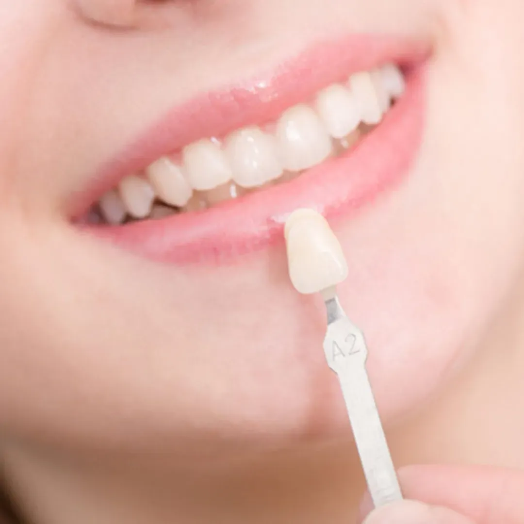Dental Veneers