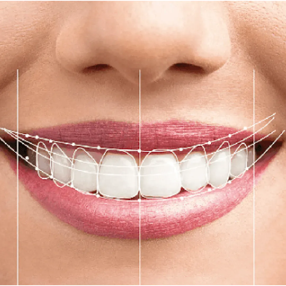 Smile Makeover